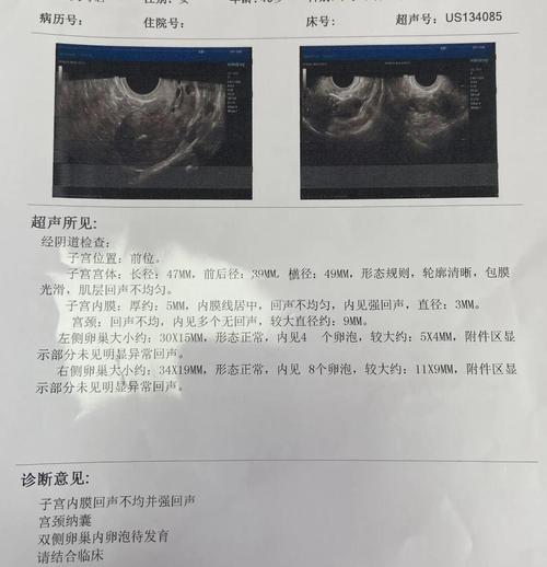 子宫监测