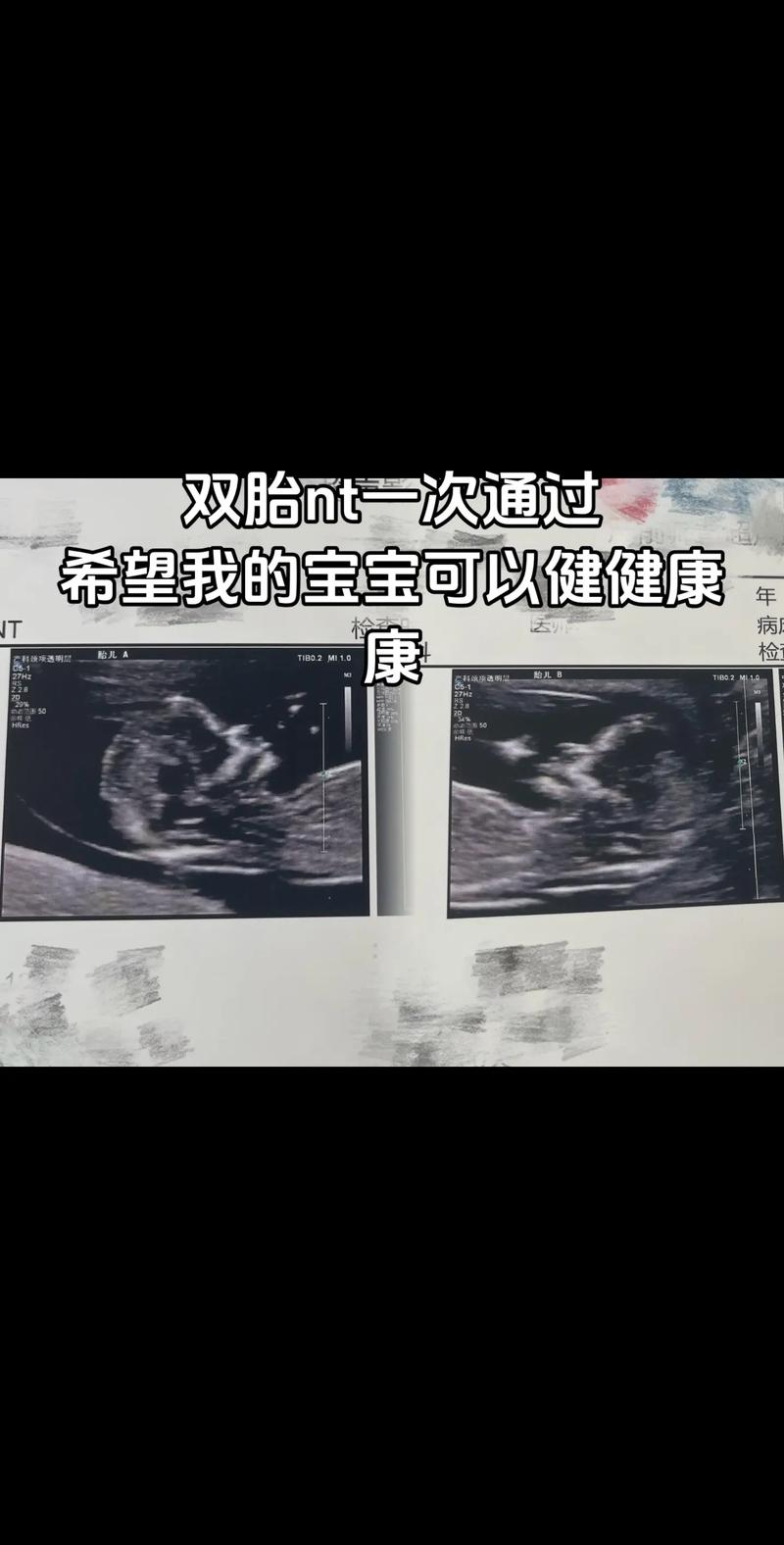  双胎成功率