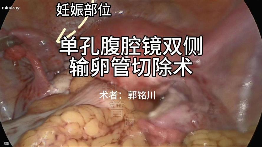 双侧卵管切除
