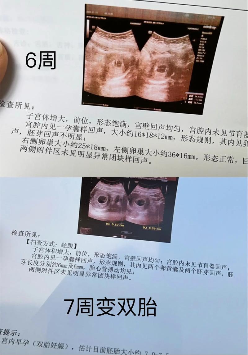 双胞胎黄囊