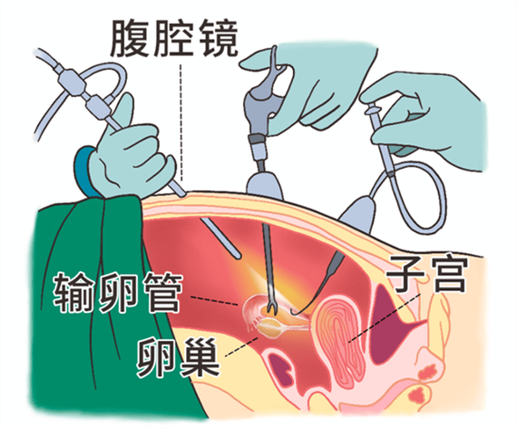 输卵管截断