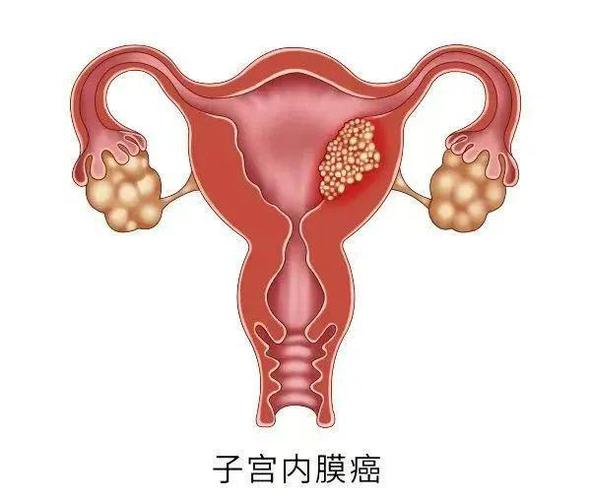  子宫内膜癌