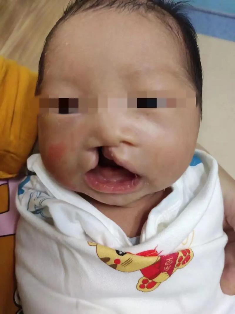  唇腭裂