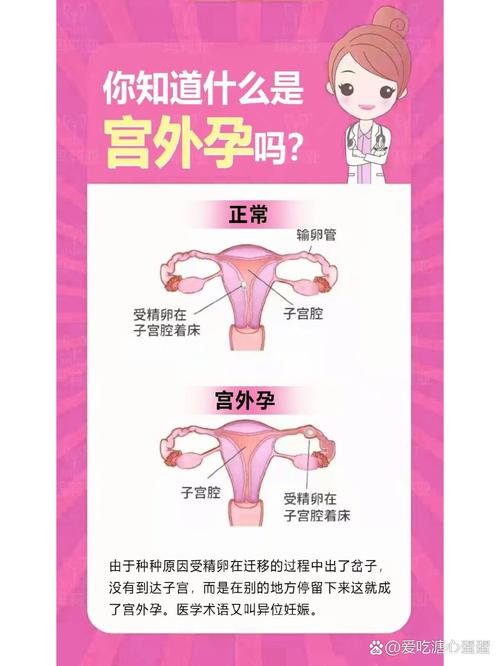 宫外孕原因