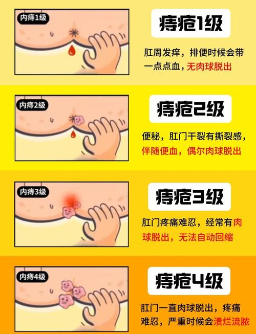  痔疮