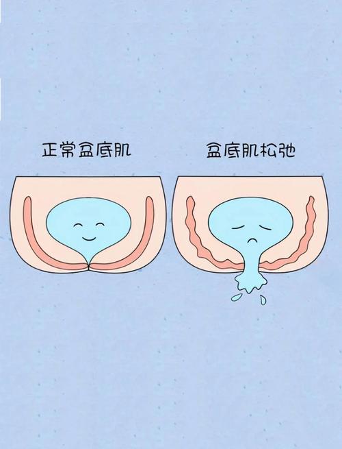 漏尿