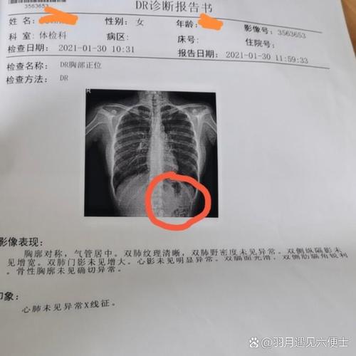  胸透