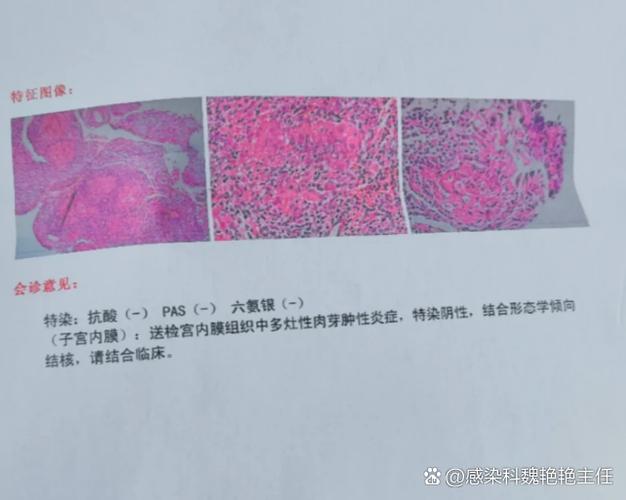 结核性内膜炎