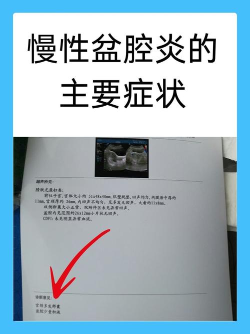  慢性盆腔炎