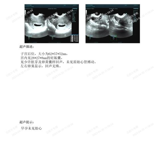 五周无胎心