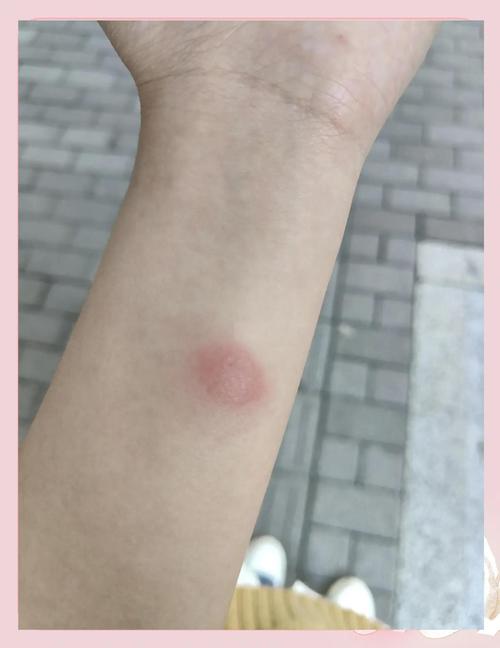  皮试阳性