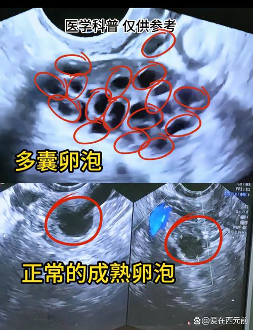 卵泡不形成胚胎