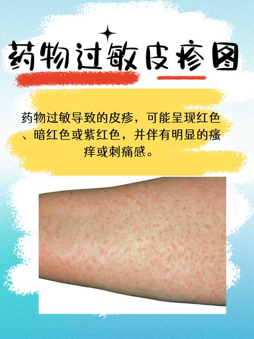  药物过敏