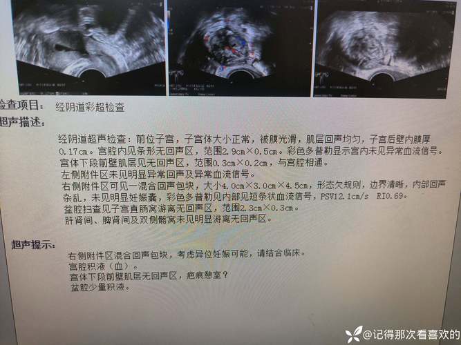  壶腹部宫外孕