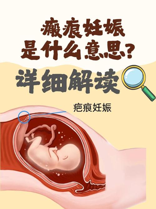  疤痕妊娠