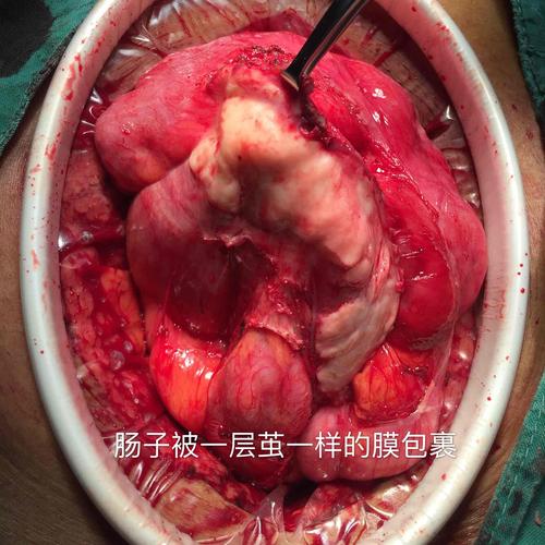 腹茧症