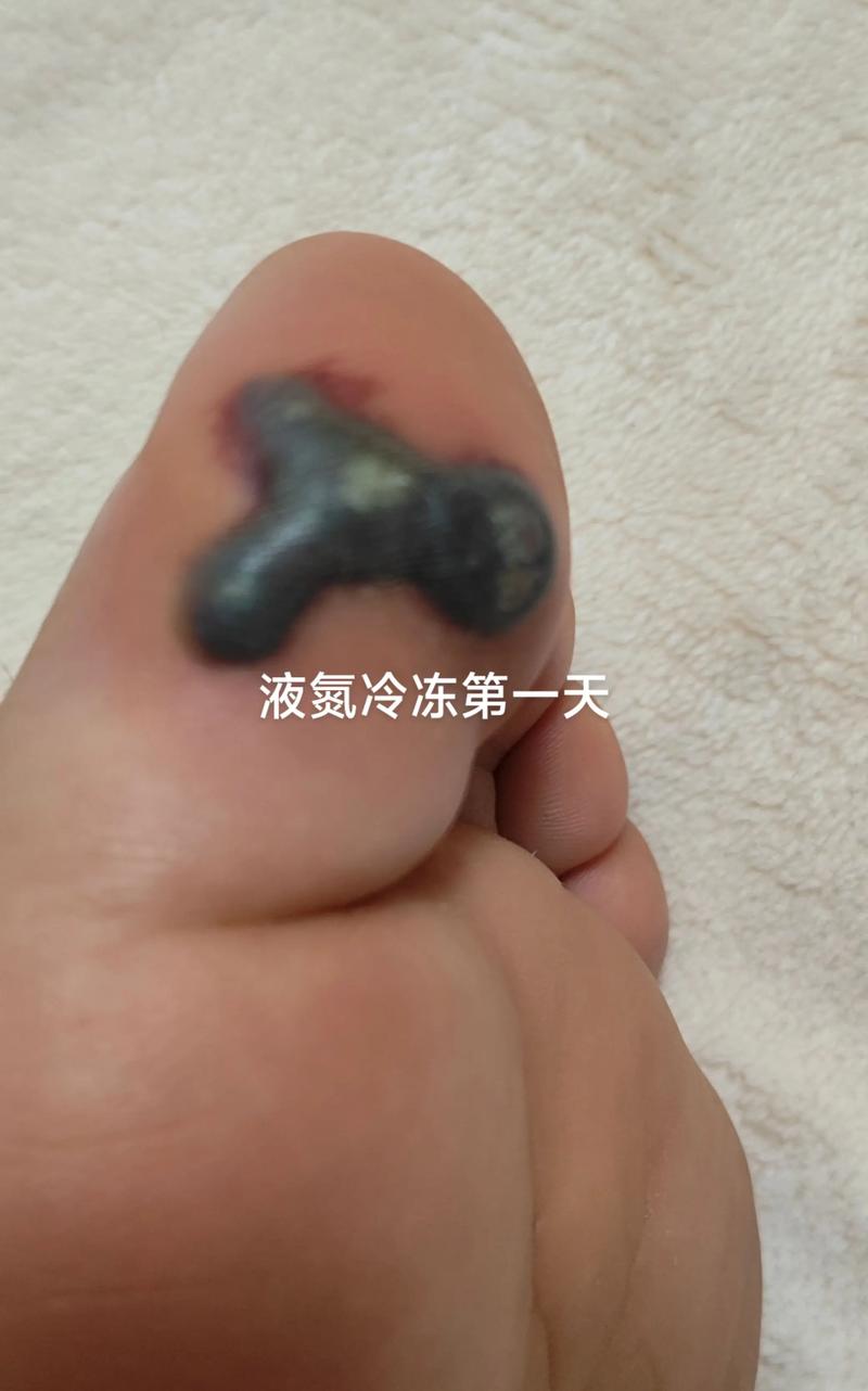  液氮冷冻