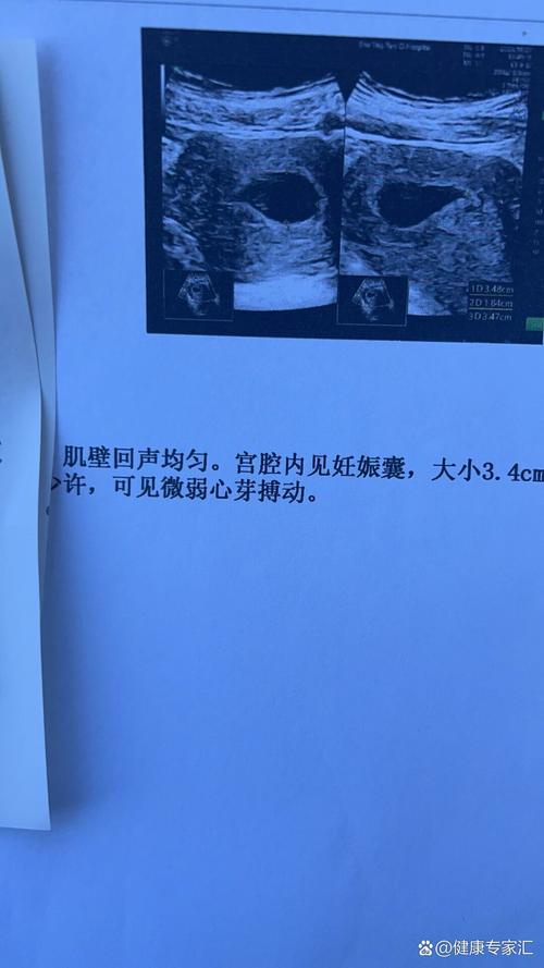 孕期胎心消失