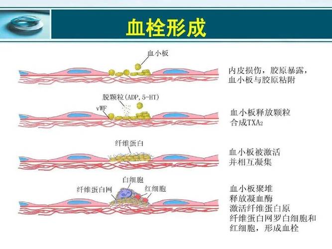  血栓形成