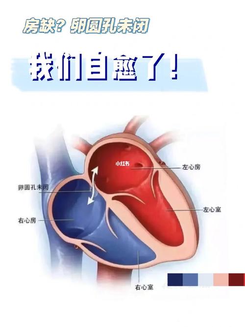  房缺