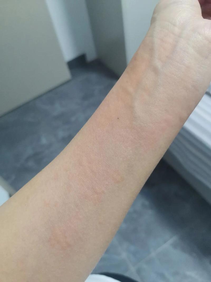  皮肤瘙痒